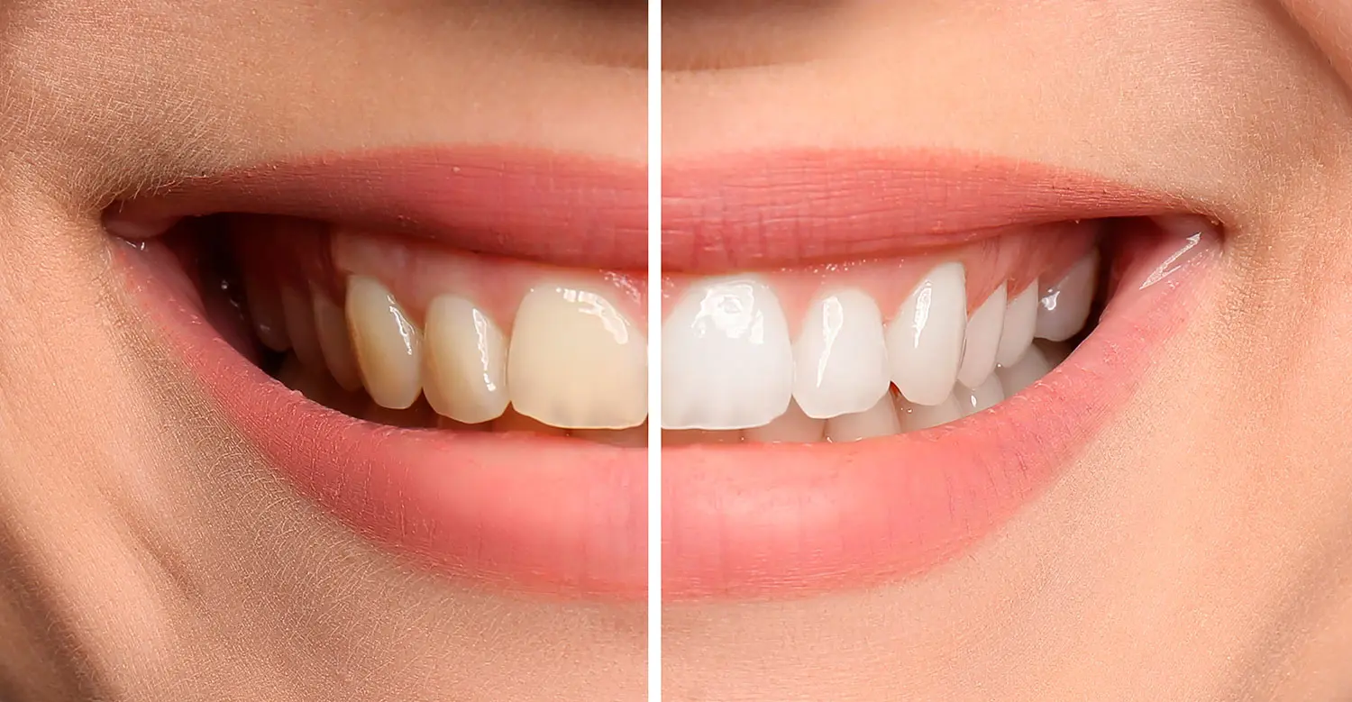 teeth-whitening-hoveton