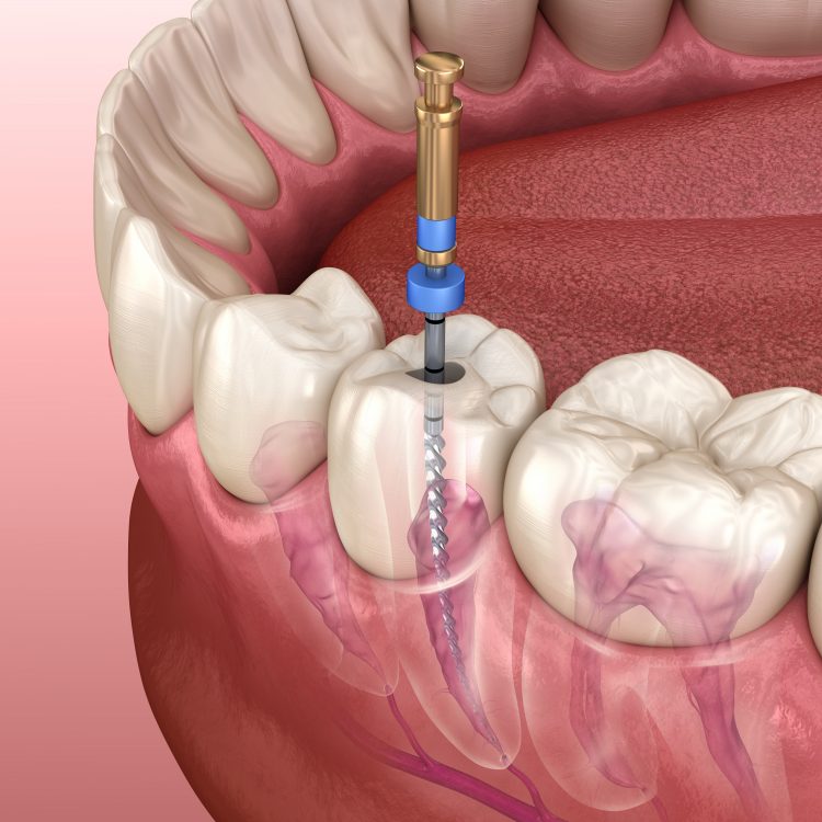 Root canal treatment process. Medically accurate tooth 3D