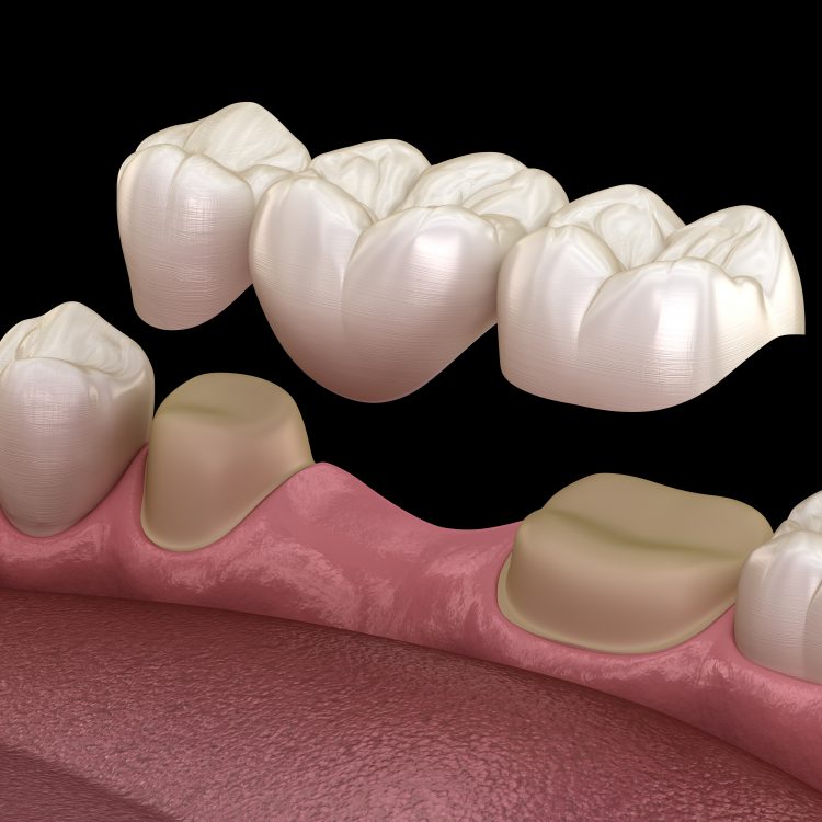 Dental bridge hoveton dental clinic